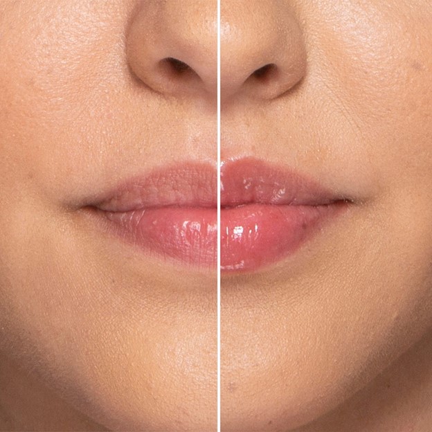 Tips for Lip Care After Fillers