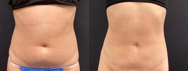 Liposuction2.jpg
